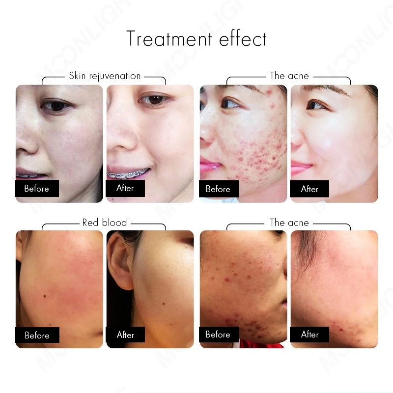 MNLT-M3 | 2-IN-1 IPL OPT + 808 Diode Laser price